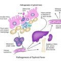 Typhoid- Causes, Symptoms, Treatment and How to prevent it?